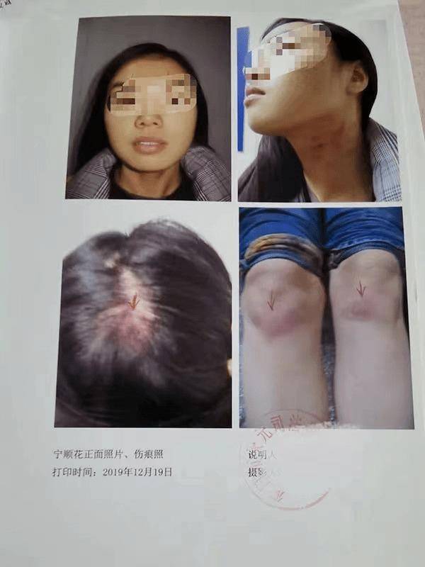 宁女士的伤势